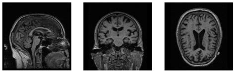 Diagnosis of Alzheimer’s Disease with Ensemble Learning Classifier and ...