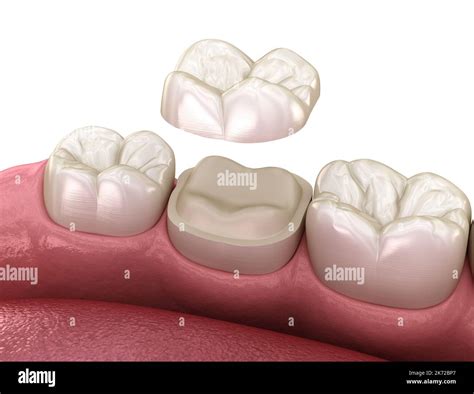 Preparation for Onlay ceramic crown fixation over tooth. Medically accurate 3D illustration of ...