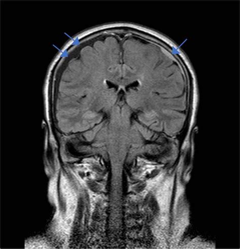 Brain MRI features of postdural puncture headache | Regional Anesthesia ...