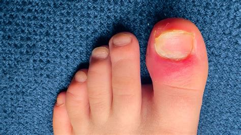Ingrown Toenails: Causes, Prevention & Expert Treatment