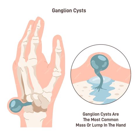 Premium Vector | Ganglion cyst fluidfilled lump under the skin of a wrist or hand synovial cyst ...