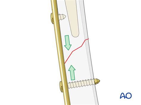 Compression Plate Fixation 的图像结果