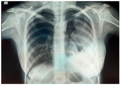Primary Chest Wall Ewing Sarcoma: Treatment and Long-Term Results