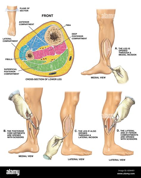 Compartment Syndrome Surgery