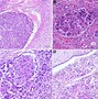 Image result for hepatocellular carcinoma