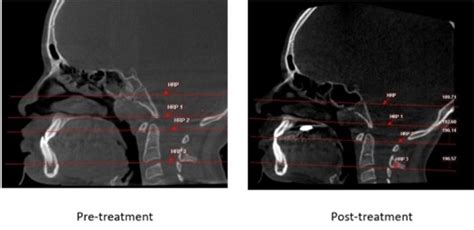 Effect of alternate rapid maxillary expansion and constriction on ...