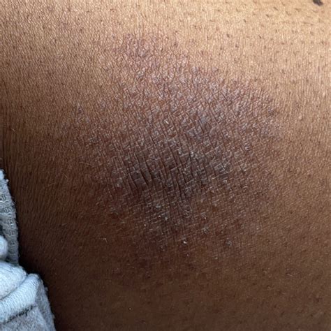 Monilial Diaper Rash Icd 10 at Lauren Brennan blog