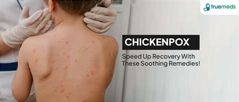 Chicken Pox Medicine