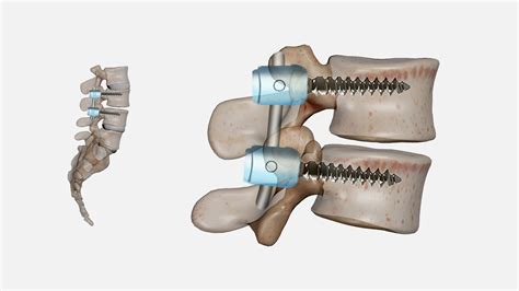 Comprehensive Guide to Spinal Fusion Surgery: Indications, Procedure ...