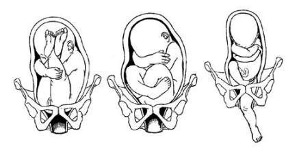 做胎位纠正操时胎儿不动怀孕31周胎位臀位_第二人生