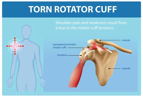 Getting Rotator Cuff Muscles Back to Function