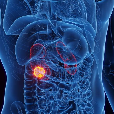 Adjuvante Therapie bei lokalisiertem RCC - Urologie & Andrologie ...