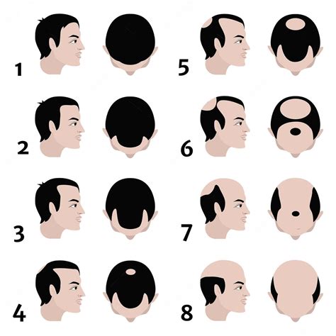 Everything You Need to Know About Baldness | Ziering Medical