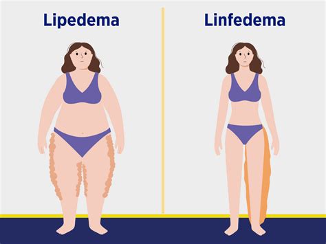 ¿Qué es la enfermedad Lipedema? - Triple-S Blog