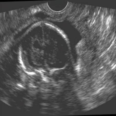 Image result for Fetalscreen II