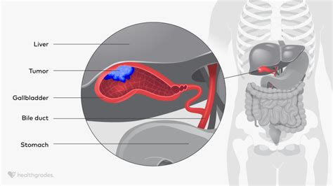 Image result for Gallbladder Cancer