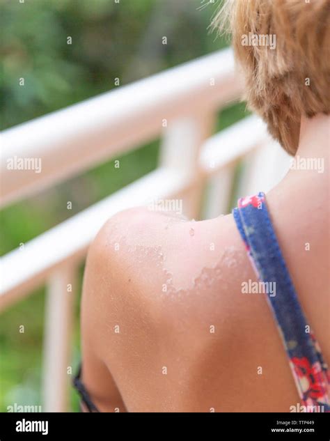 Sunburned hi-res stock photography and images - Alamy