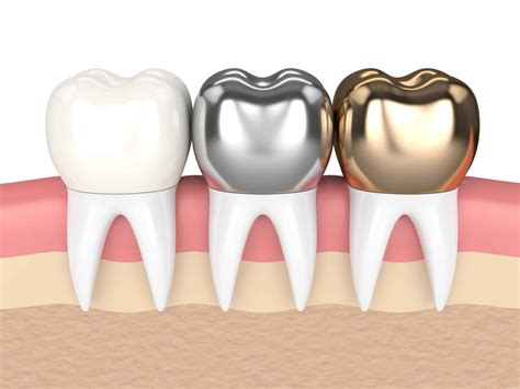 Dentist in Birmingham MI | Birmingham Dentist | Different types of dental crowns