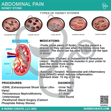 Kidney Stone Pain Chart Pain Locator: Where Does It Hurt? NYC