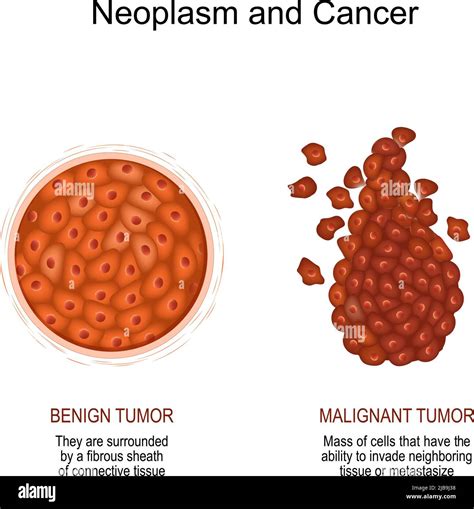 Neoplasm and Cancer. Comparison and difference of a malignant and benign tumor. benign tumor ...