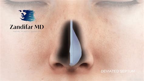 What are the signs You May Have A Deviated Septum - Zandifar MD