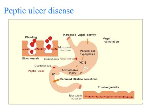 peptic ulcer management and Treatment ppt | PPT