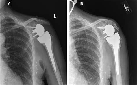 X Ray Of Reverse Total Shoulder Replacement at Jaclyn Glenn blog