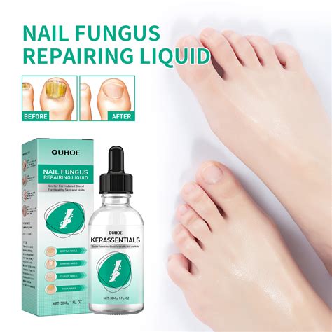 OUHOE Toenail Repair Solution - For Thickened, Yellowing, Brittle Nails ...