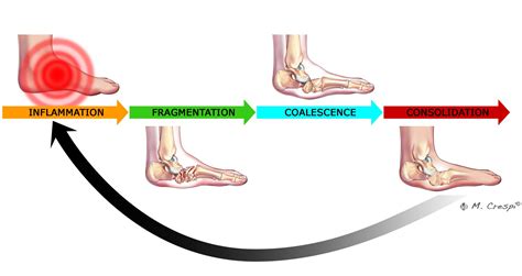 Charcot Arthropathy Symptoms and Initial Stage - Orthofix