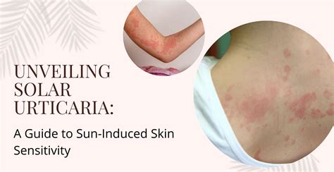 The Difference Between A Sun Allergy And Sun Sensitivity