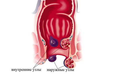 Наружный геморрой – симптомы, лечение у женщин при беременности