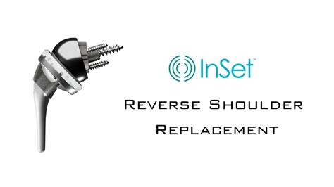 What is Reverse Shoulder Replacement Surgery - Jessica Churchill, MD