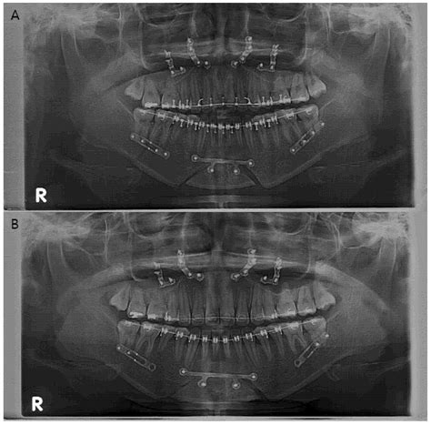 Correction of Condylar Displacement of the Mandible Using Early Screw ...