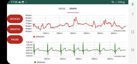 Image result for PVC ECG Reading