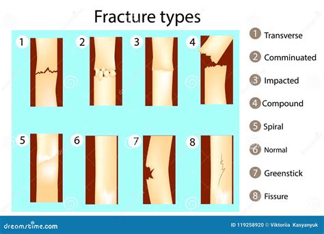 Fracture types of bones. stock vector. Illustration of educational ...