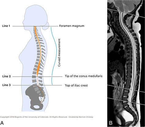 The conus medullaris ratio: A new way to identify tethered cord on MRI ...
