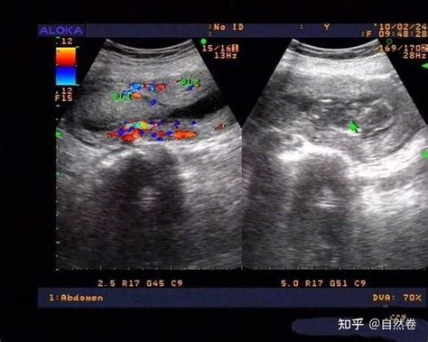 磷脂抗体综合征（评分6分）孕15周发现胎停，再次怀孕该怎么办？ - 知乎