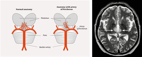 Artery of Percheron occlusion | Tidsskrift for Den norske legeforening