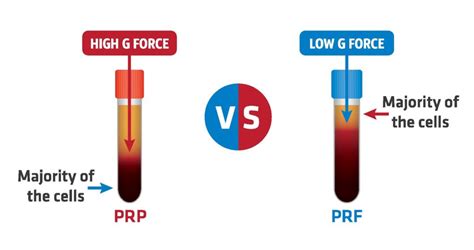 prf-vs-prp-1 - GP IMPLANT