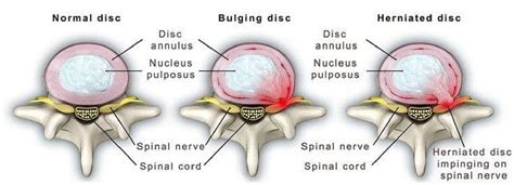 Bulging Disc Example 的图像结果