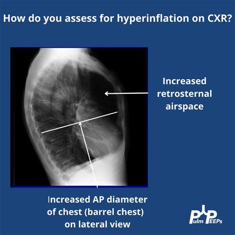 Barrel Chest Copd