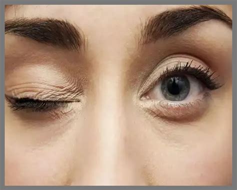 homeopathic treatment for Eye blinking in homeopathy, Eye blinking ...