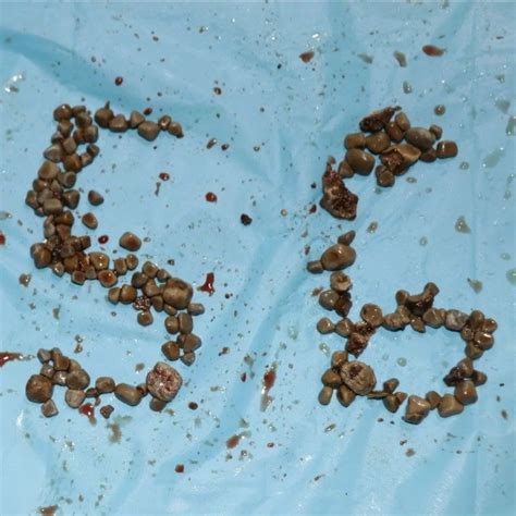 Real Kidney Stones