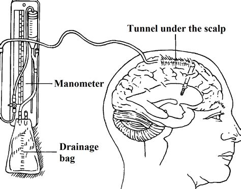 About Brain Aneurysms – Clínica Neuros | Neurocirujano Valencia
