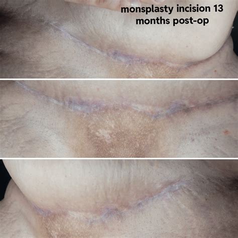 Metoidioplasty - 13 months post-OP (release, labiaplasty and monsplasty). No v-nectomy, so some ...
