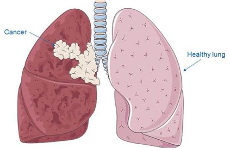 Emphysema Life Expectancy 的图像结果