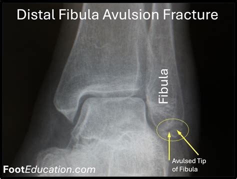 Avulsion Fractures Radiology
