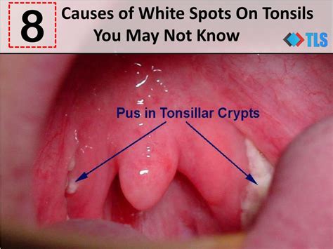 White Spots On Wall Of Throat at Mike Lyles blog