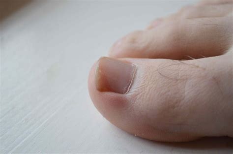 Can Wearing Too Small Shoes Damage Your Toenails