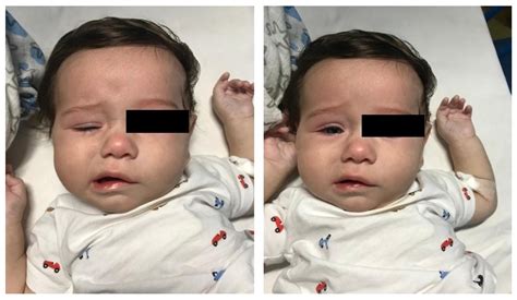 Kawasaki Disease Children